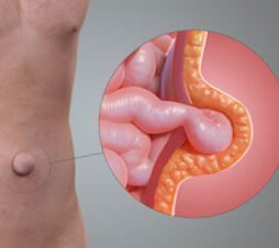 ventral hernia robotic surgery dr javed bengaluru