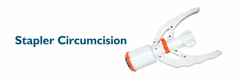 stapler-circumcision