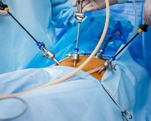 laparoscopic cholecystectomy dr javed bengaluru